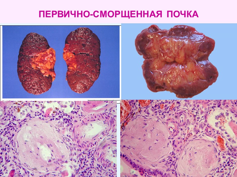 ПЕРВИЧНО-СМОРЩЕННАЯ ПОЧКА